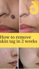 Mole Erase Remove Skin Tags Mole Freckle Care Solution