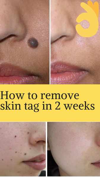 Mole Erase Remove Skin Tags Mole Freckle Care Solution