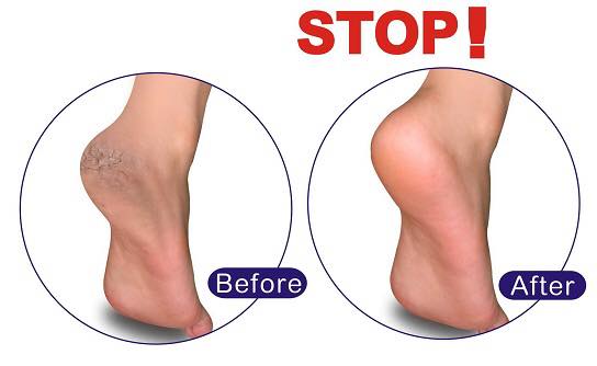 Bioway The Banana Cream Heels for Hydrating Cracked Heels, Elbows & Knees
