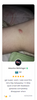 Lanbena TCM Scar And Acne Mark Removal Gel Ointment