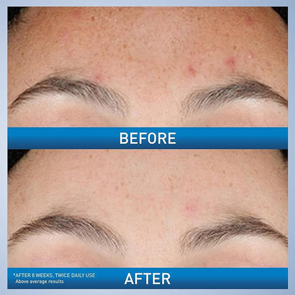 CeraVe Resurfacing Retinol Serum With Ceramides & Niacinamide For Blemish-Prone Skin 30 mL