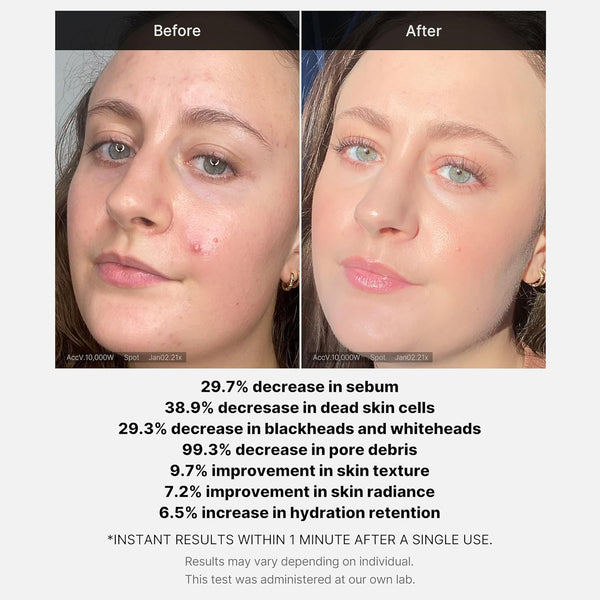 medicube Red Acne Succinic Acid Peel 40g (1.41 oz)