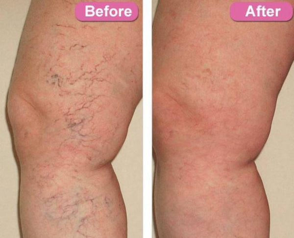 PhiloSoft LegActif Cream for Varicose Veins, Leg Swelling & Stretch Marks
