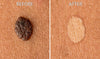 Mole Erase Remove Skin Tags Mole Freckle Care Solution